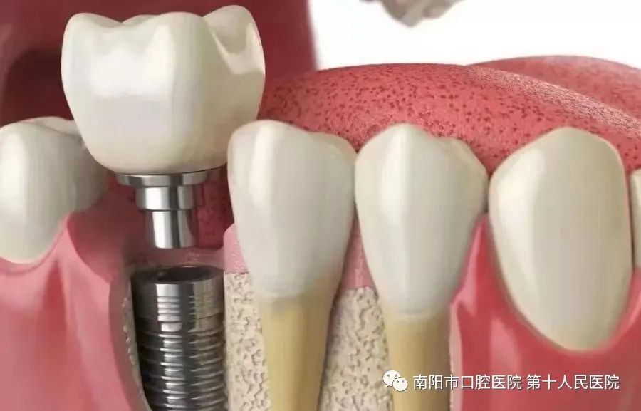 一篇圖文帶你了解種植牙(圖3)