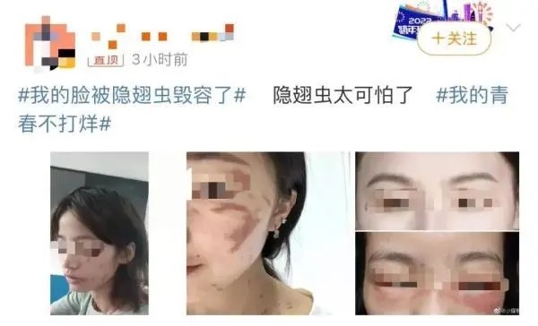 隱翅蟲的毒液堪比硫酸！專家提醒：見到千萬別拍(圖2)